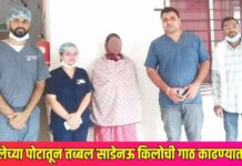 महिलेच्या पोटातून तब्बल साडेनऊ किलोची गाठ काढण्यात यश ; डॉ. उल्हास पाटील रुग्णालयातील तज्ज्ञ डॉक्टरांची यशस्वी शस्त्रक्रिया